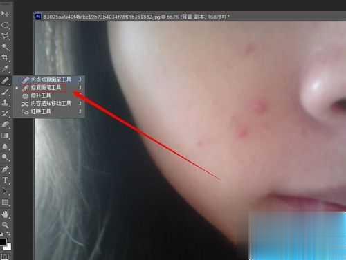 ps怎么去掉脸上的痘痘(4)